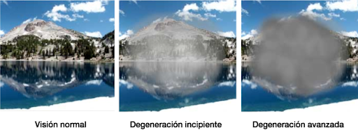 Maculopati img